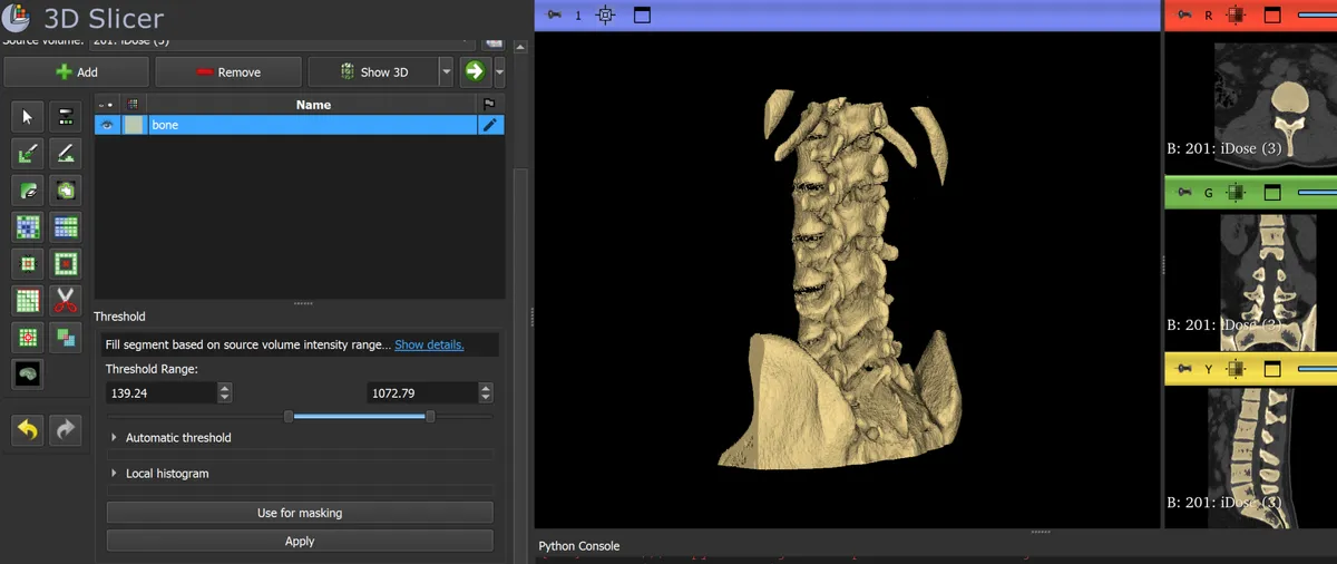 Thresholding bone by Hounsfield units in 3D Slicer