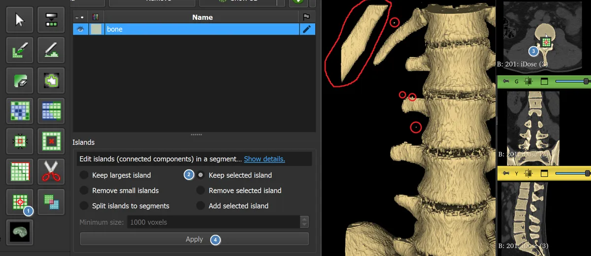 Using Islands, Keep Selected Island, to clean the segmentation