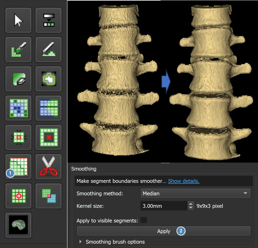Smoothing the segmented bone model in 3D Slicer